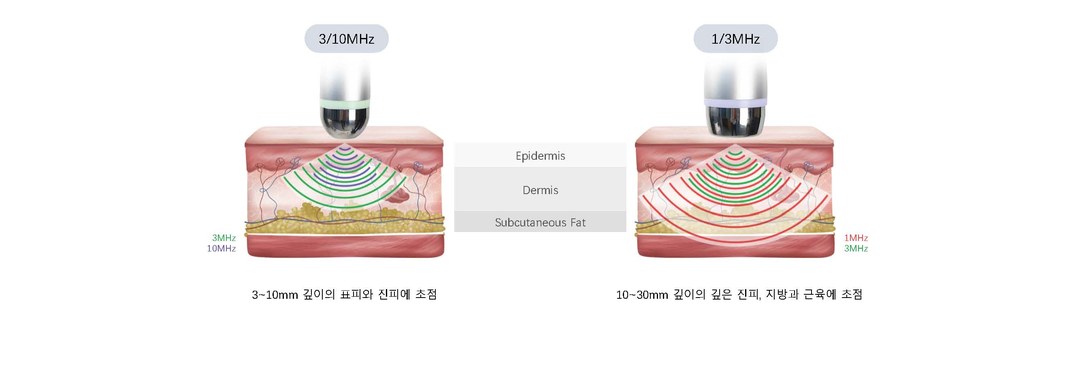 초음파 이중 주파수 크로싱 기술 피부 침투 깊이 도식