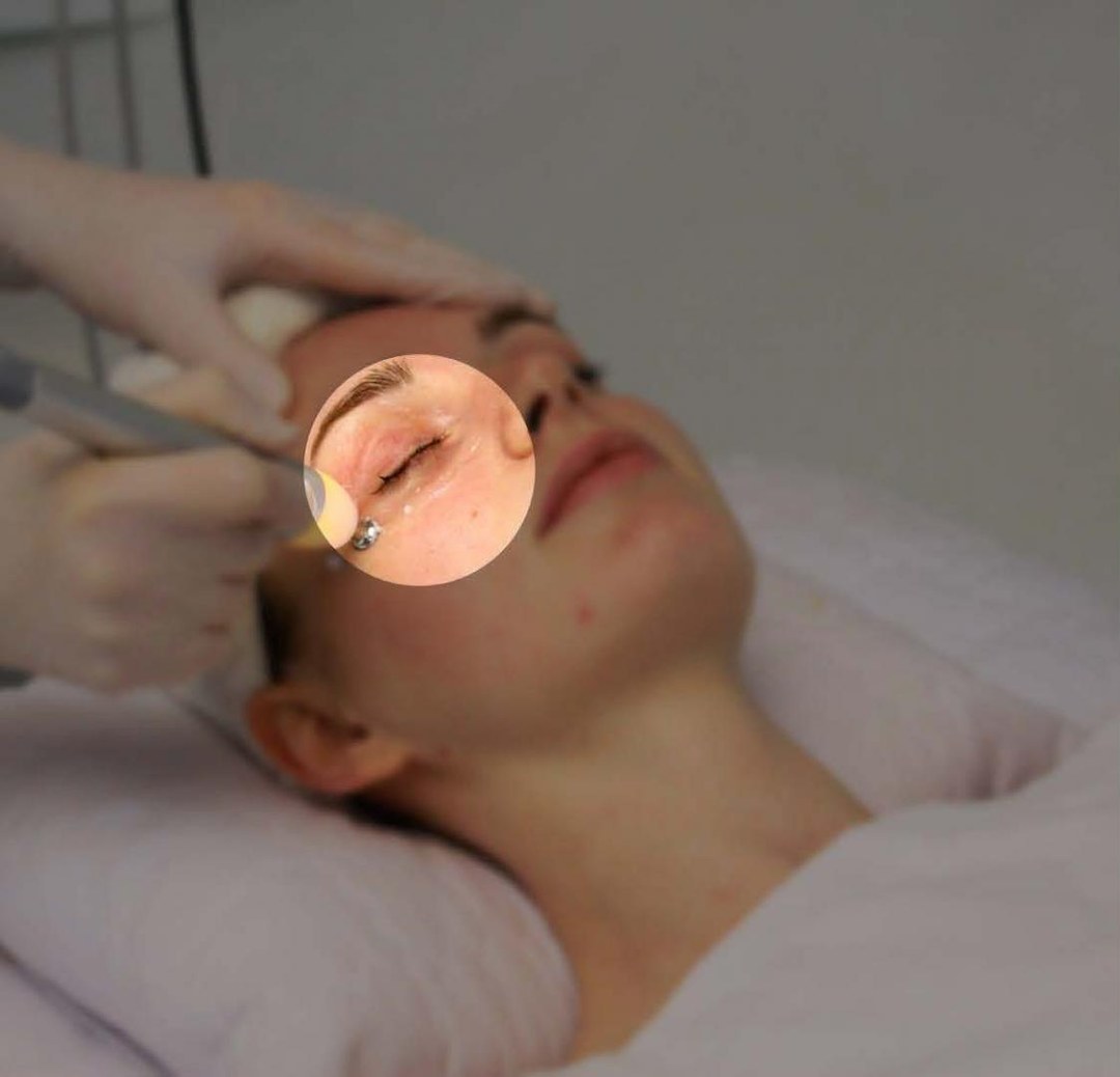 LUCERA 10s 눈가 케어 시술 장면