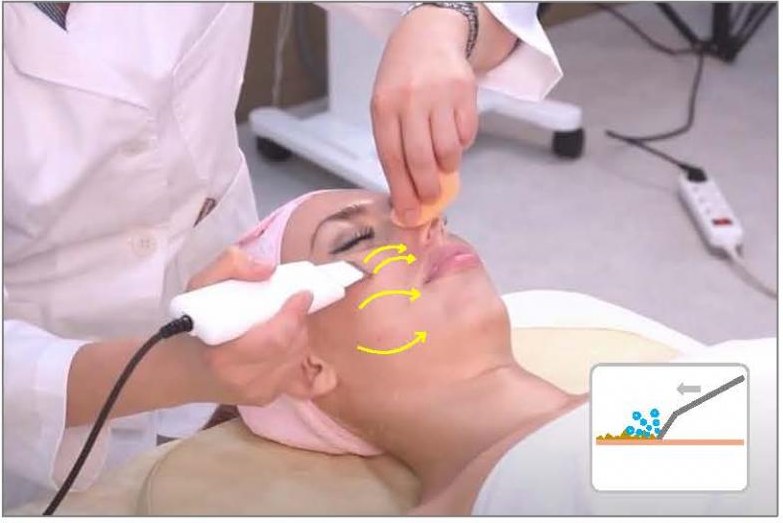 스크러버 각질제거 시술 사진