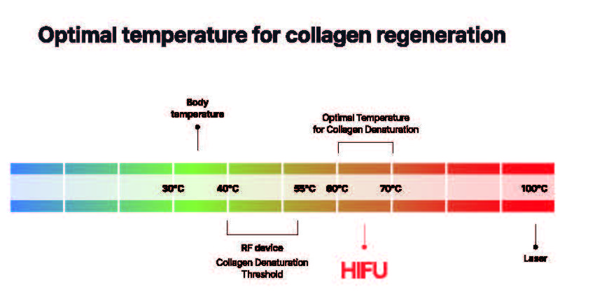 온도 차트: 30°C 40°C 55°C 60°C 70°C 100°C, Body temperature, RF device Collagen Denaturation Threshold, Optimal Temperature for Collagen Denaturation(HIFU), Laser