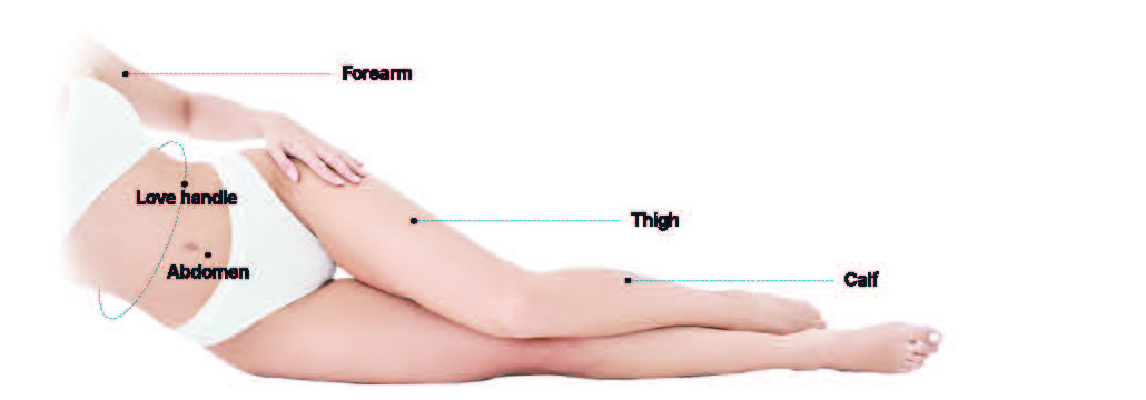 Body 시술 부위: Forearm, Love handle, Abdomen, Thigh, Calf